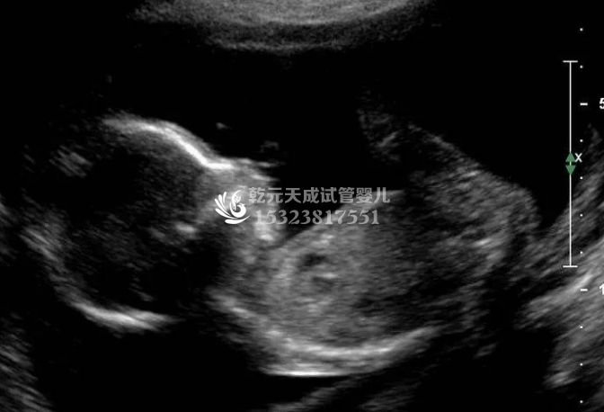 做泰国试管婴儿怀孕了，做B超会伤害胎儿吗? 