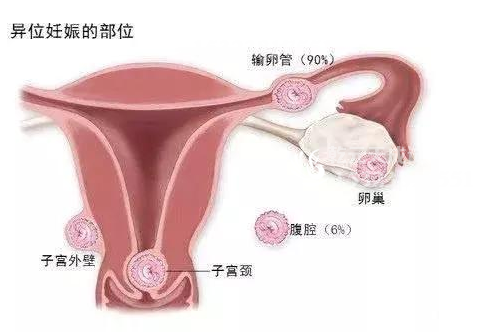 为什么做试管婴儿还会发生宫外孕？请给个合理的解释！