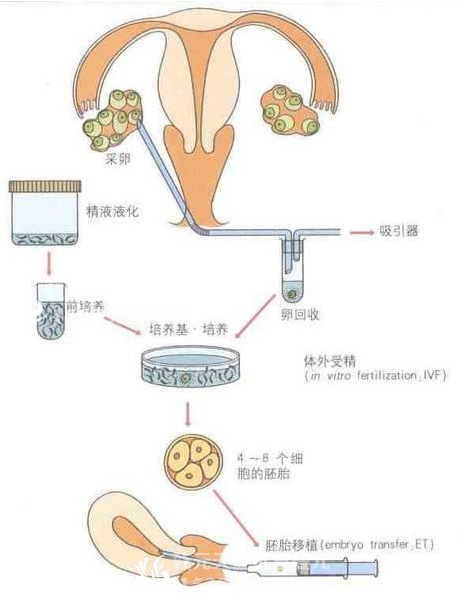 泰国试管婴儿治疗过程中，钱都花到哪里去了？