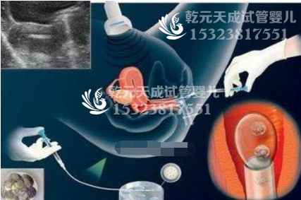 试管婴儿移植后出血，这种情况是移植失败了吗？